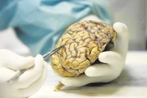 Cerebros que resisten el Alzeimer